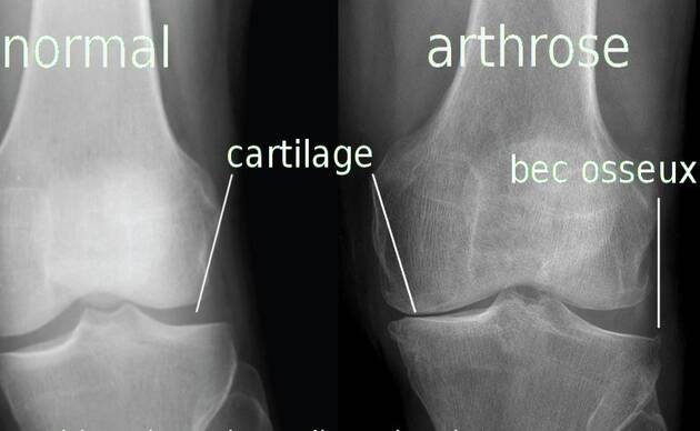 Les genouillères en cas d'arthrose du genou
