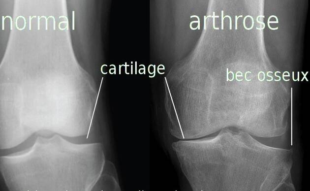 Semelle orthopédique douleur genou online