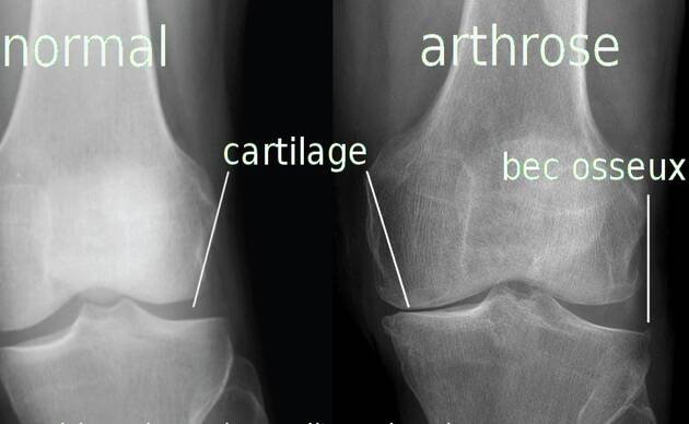 Soulager l'arthrose du genou (gonarthrose) : genouillère arthrose