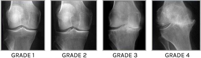 Arthrose du genou - Douleur d'arthrose au genou